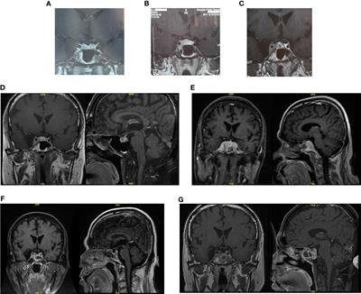 Case Report: Identification of Potential Prognosis-Related TP53 Mutation and BCL6-LPP Fusion in Primary Pituitary Lymphoma by Next Generation Sequencing: Two Cases